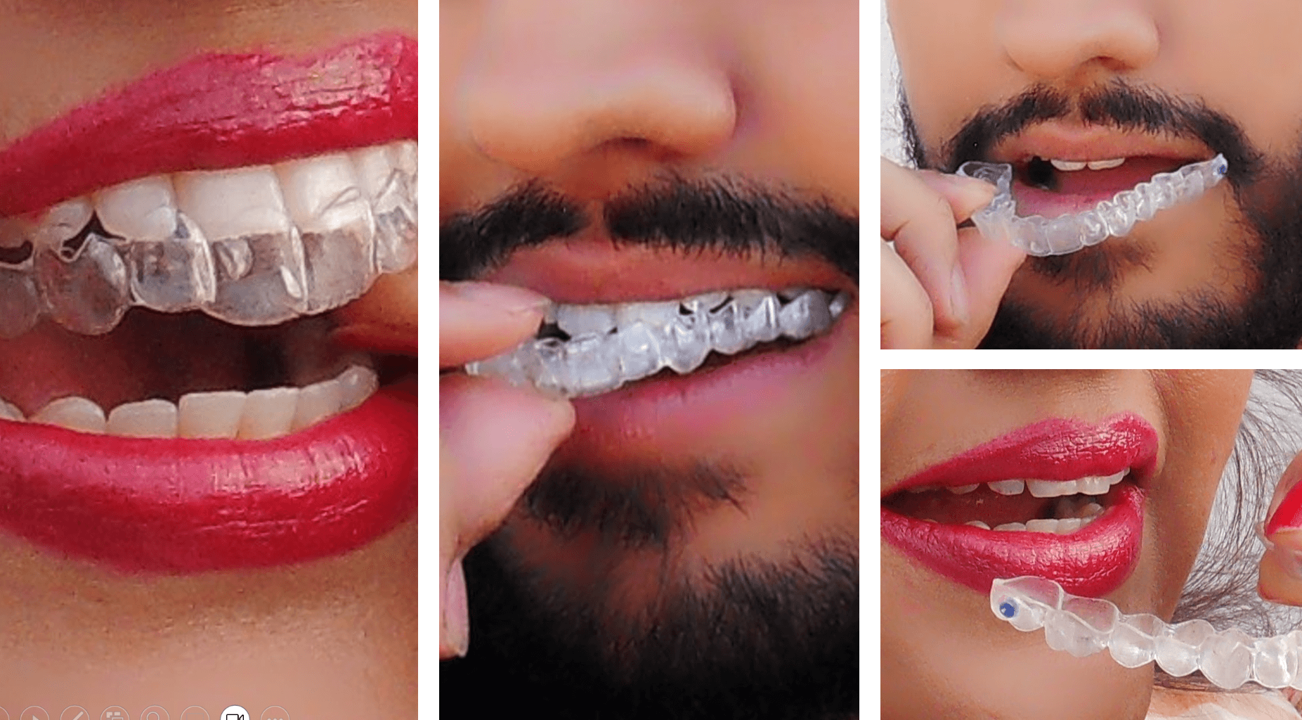 Unsichtbare Zahnspange Wien – Invisalign oder Clear Aligners