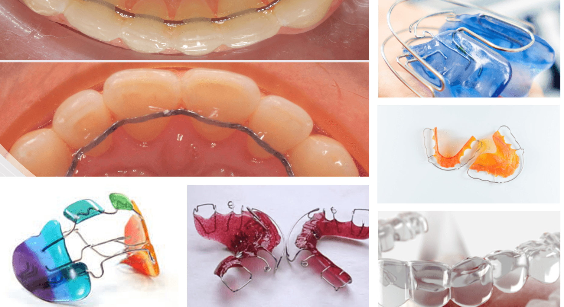 Ablauf Zahnspange – Impression 3