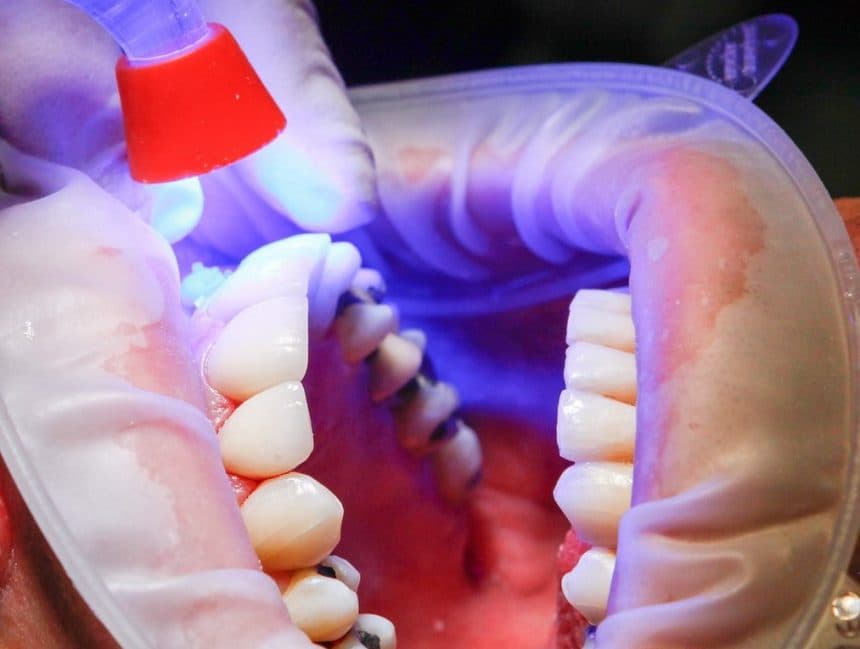 Ablauf: Zahnspange & Kieferorthopädie – Bild 3