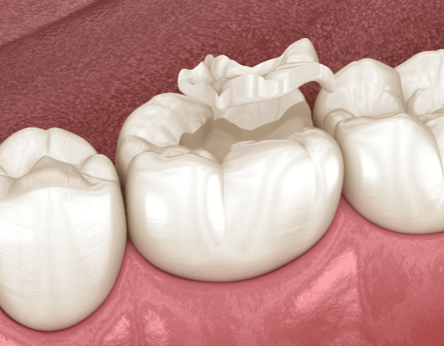 Keramik / ästhetische Versorgung