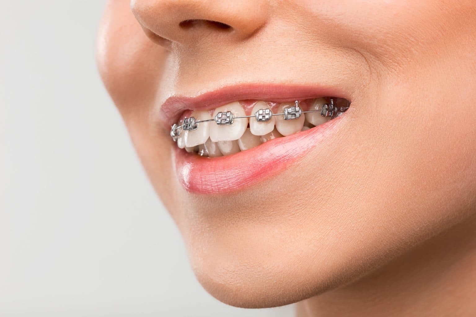 Junge Frau mit Metallbrackets