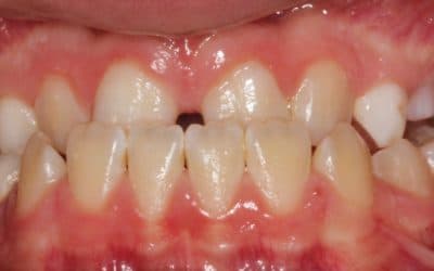 Kieferorthopädische Frühbehandlung im Kindesalter