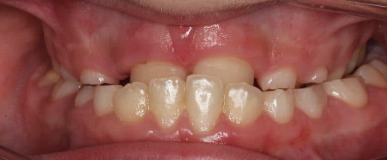 Engstand und Platzmangel im Kindergebiss