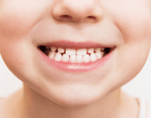 Kind mit Zahnspange in kieferorthopädischer Behandlung