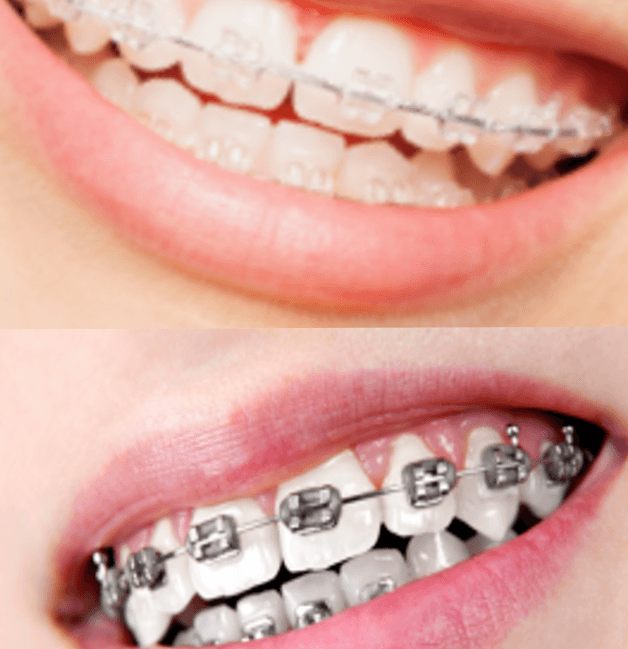 Metal brackets for teenagers