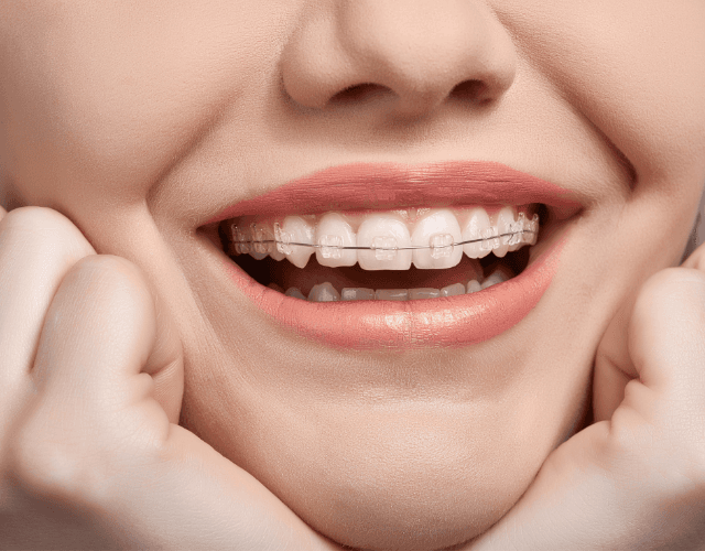 Clear ceramic braces