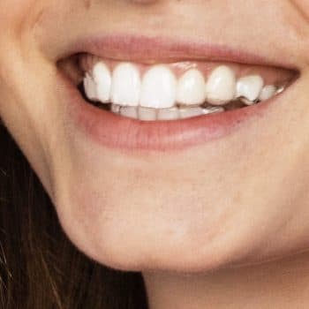 Clear aligner trays