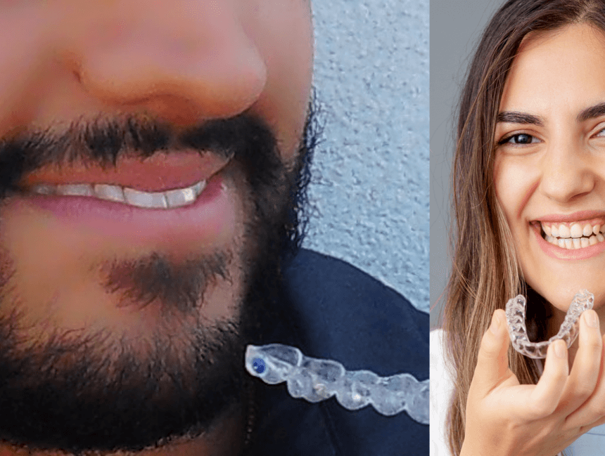 Lingual braces on the inside of the teeth