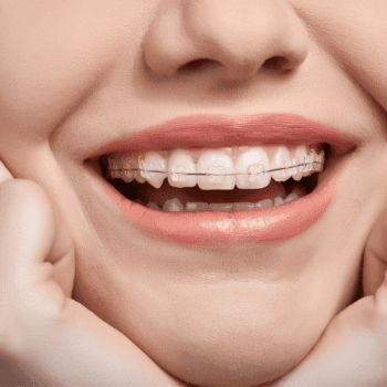 Fixed metal braces