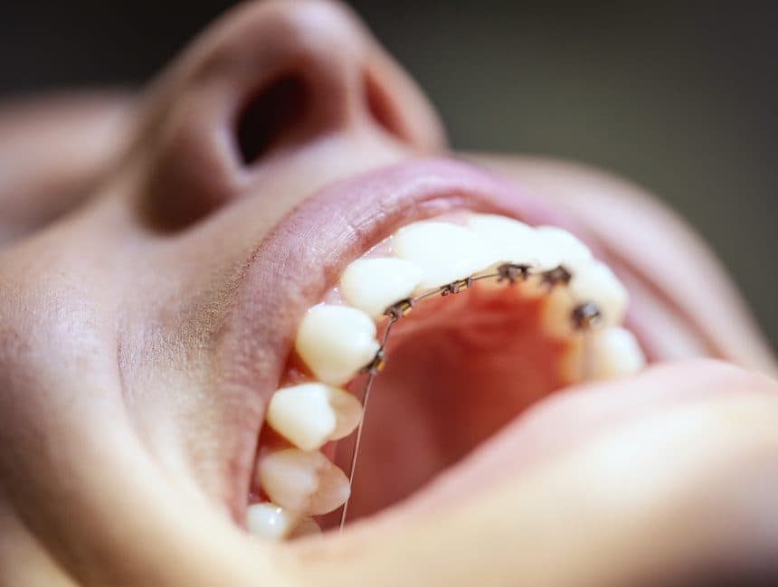 Adult patient with aesthetic braces