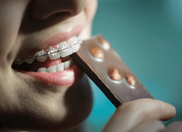 Ceramic brackets as a private option