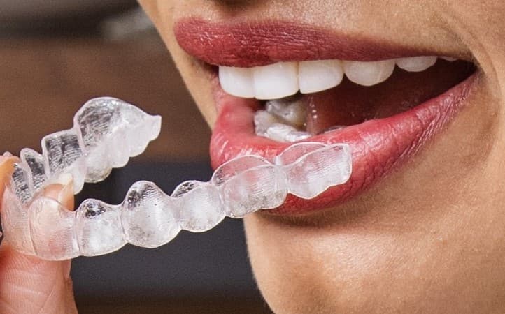 Nahaufnahme: durchsichtige Aligner-Schiene vor dem Gebiss