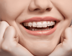 Keramikbrackets mit dünnem Metallbogen