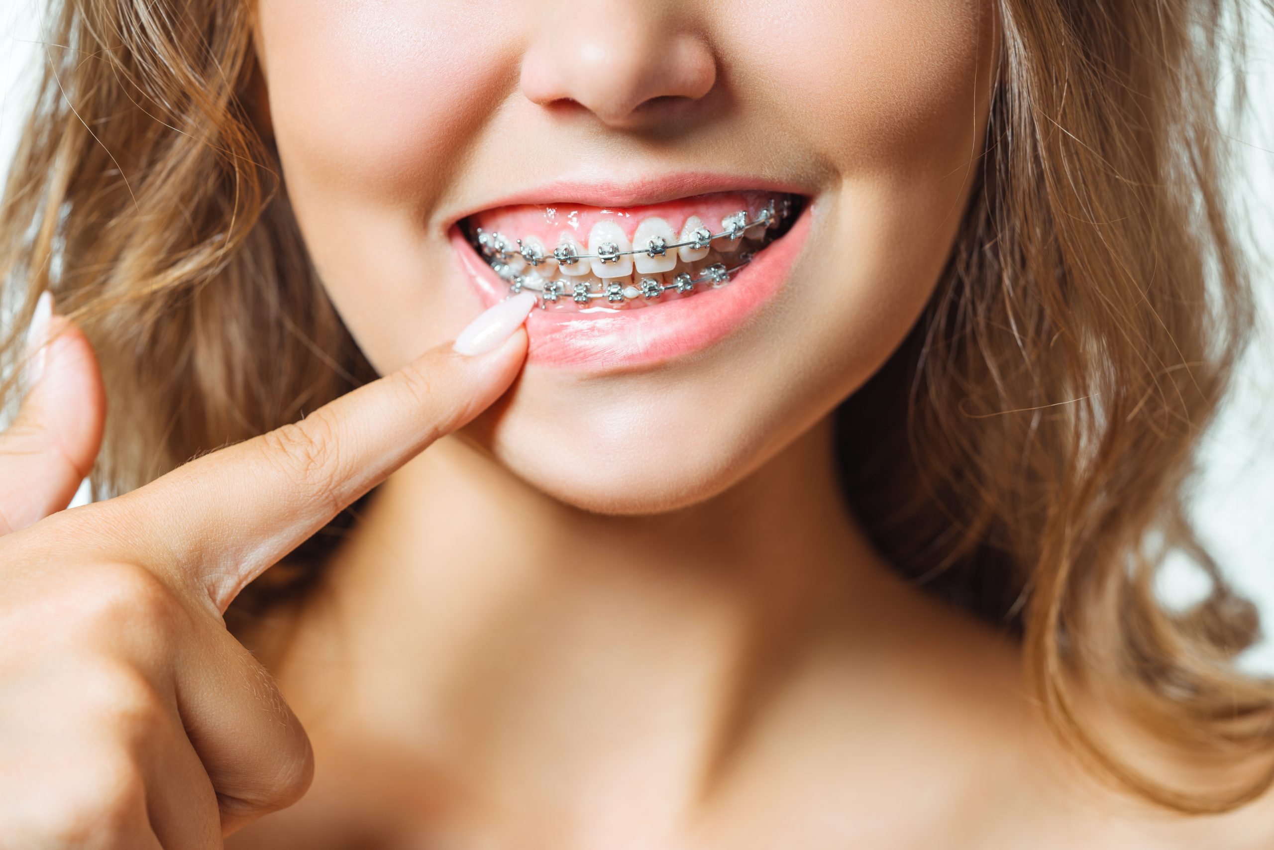 Patientin mit Keramikbrackets